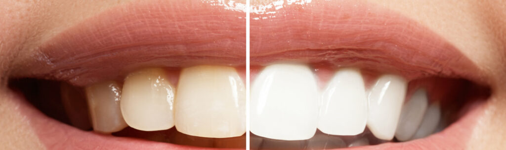 Before and after teeth whitening comparison