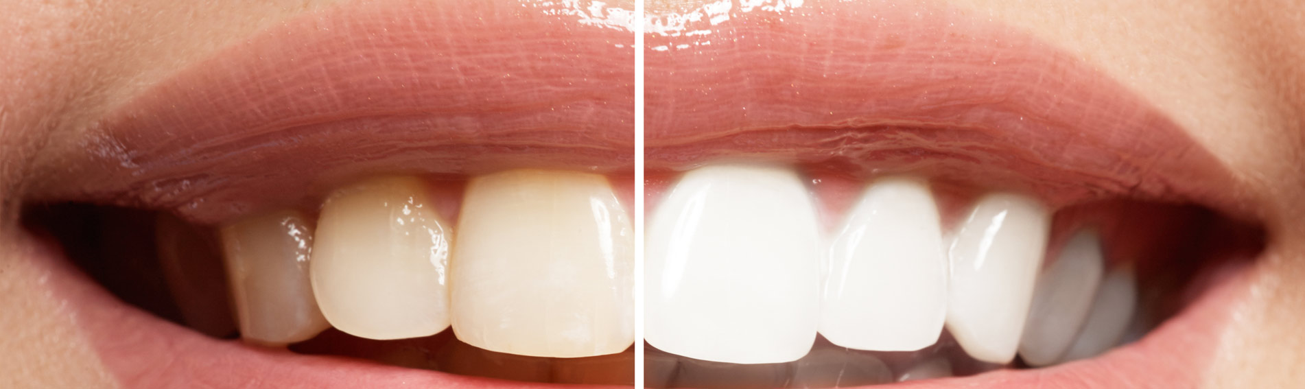 Teeth whitening